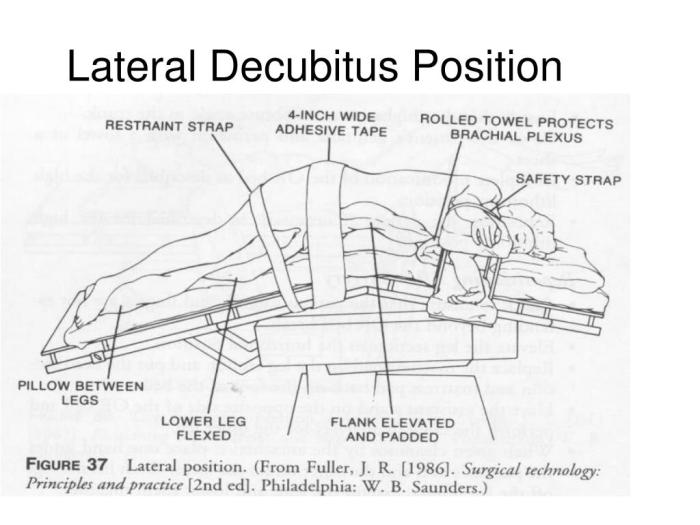 Decubitus intravenous portion